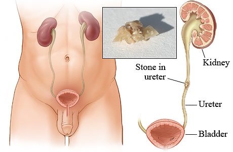 kidney stone removal treatment in Gota