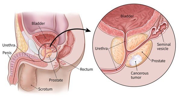 Prostate Cancer Treatment in Gota