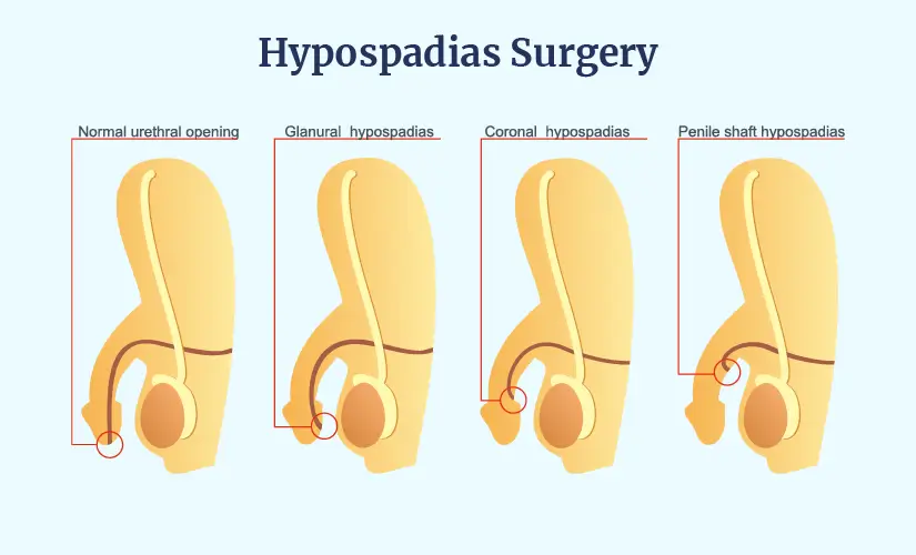 Advanced Hypospadias Treatment & Reconstruction in Ahmedabad