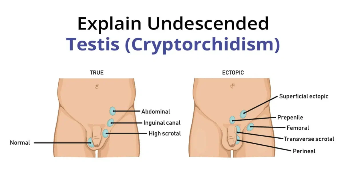 Advanced Orchiopexy Procedure for Cryptorchidism in Ahmedabad