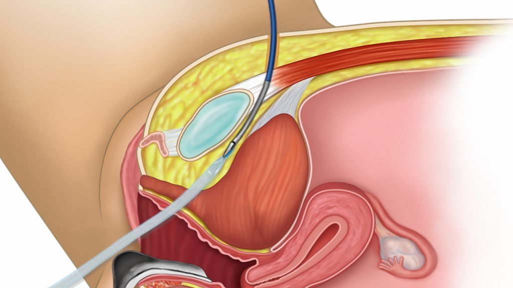 Best Bladder Sling Surgery in Ahmedabad for Urinary Incontinence Treatment