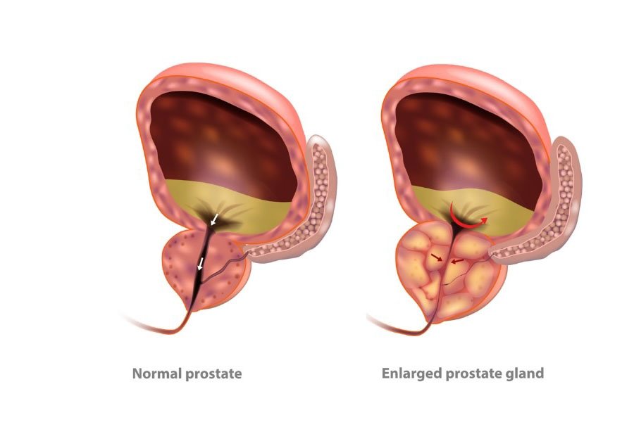 Best Enlarged Prostate BPH Treatment in Ahmedabad