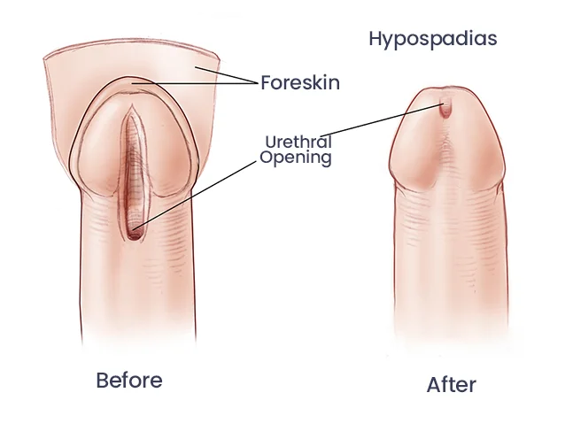 Best Epispadias Treatment & Surgery in Ahmedabad