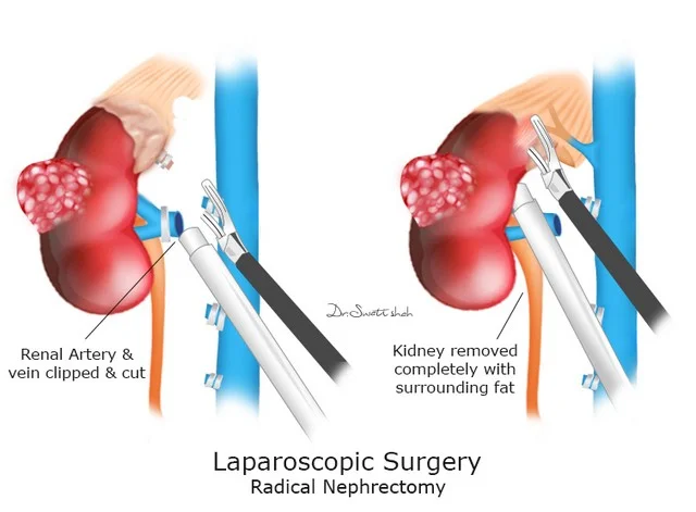 Best Laparoscopic Nephrectomy Surgery in Ahmedabad