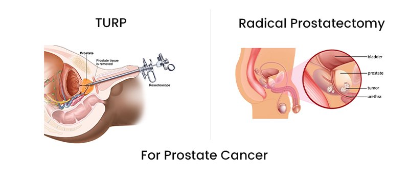 Best Laparoscopic Radical Prostatectomy Surgery in Ahmedabad