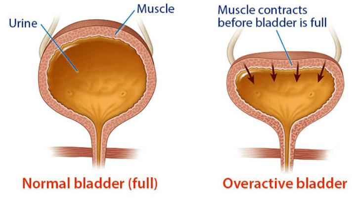 Best Overactive Bladder (OAB) Treatment in Ahmedabad