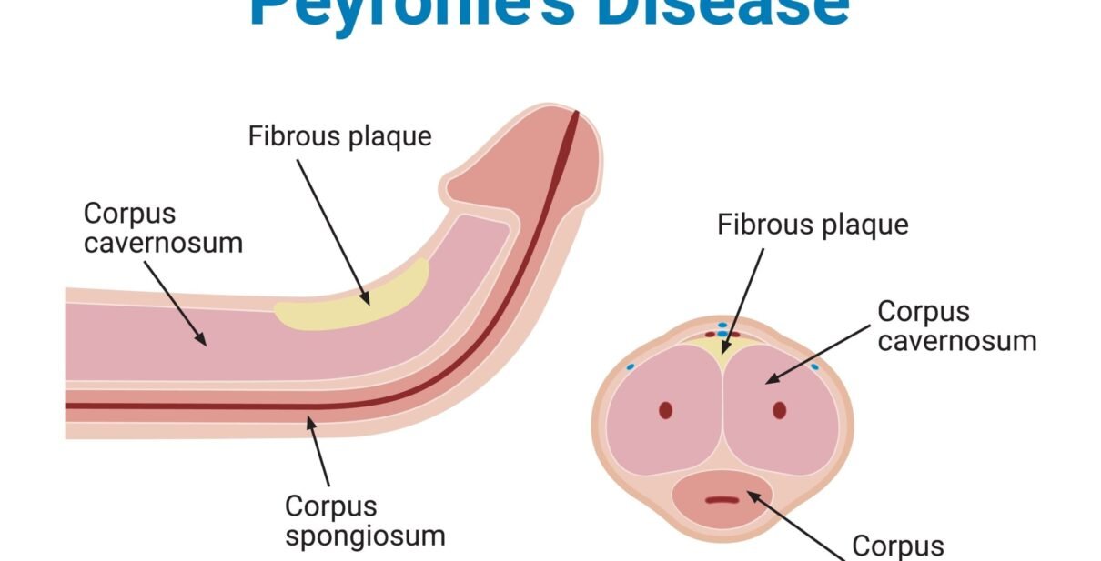Best Peyronie’s Disease Treatment in Ahmedabad