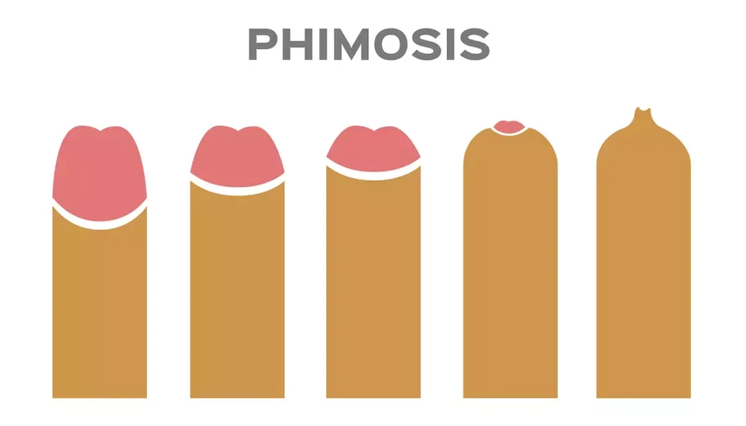 Best Phimosis Treatment