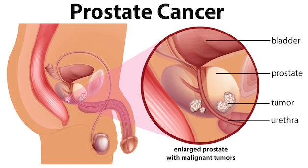 Best Prostate Cancer Treatment in Ahmedabad