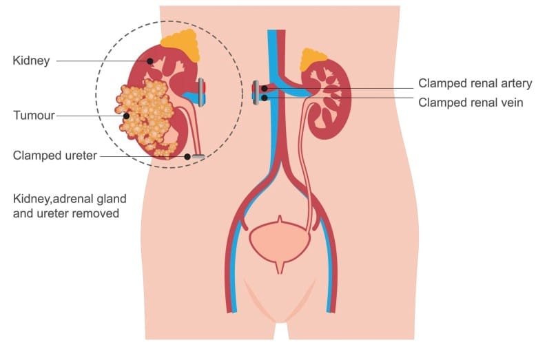 Best Robotic Radical Nephrectomy Surgery in Ahmedabad