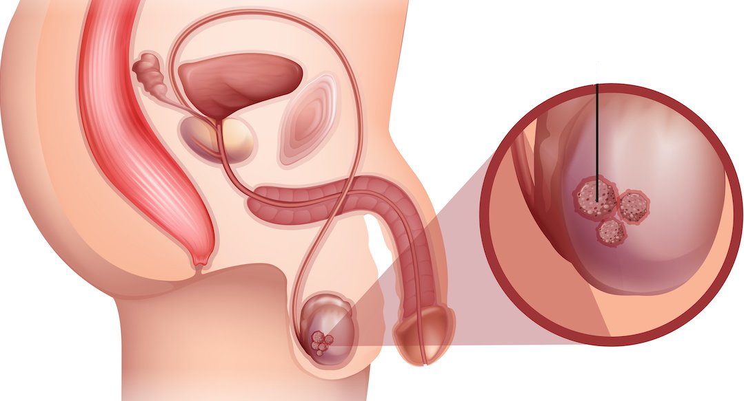 A Male Anatomy of Testicular Cancer