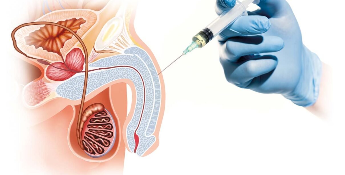 Best Treatment for ED - P Shot