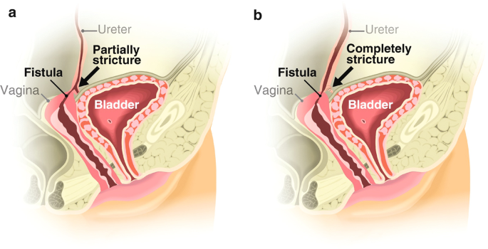 Best UVF & VVF Treatment & Surgery in Ahmedabad