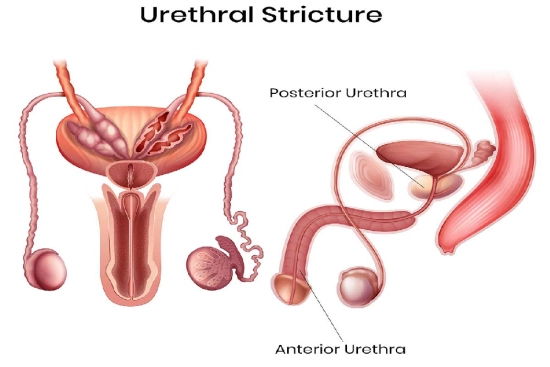 Best Ureter Stricture Treatment in Ahmedabad