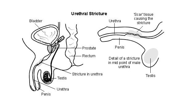 Best Urethral Stricture Treatment in Ahmedabad