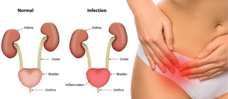 Best Urinary Tract Infection Treatment in Ahmedabad