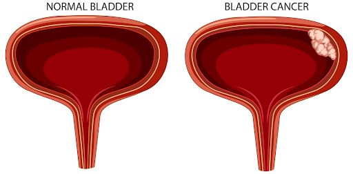 Bladder Cancer Treatment & Management in Ahmedabad