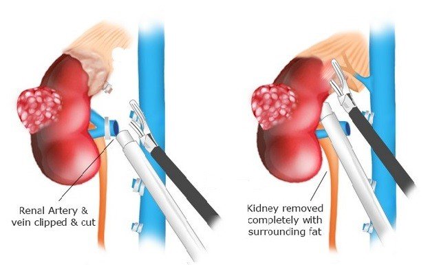 Laparoscopic Radical Nephrectomy Surgery