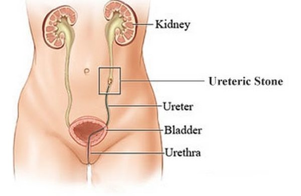 Laparoscopic Ureterolithotomy for Stone Removal