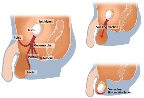 Orchiopexy Treatment for Cryptorchidism