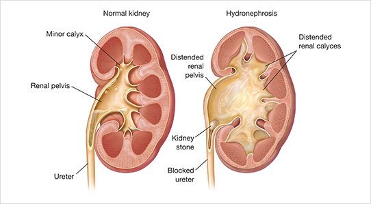 PUJ Obstruction Treatment & Surgery in Ahmedabad