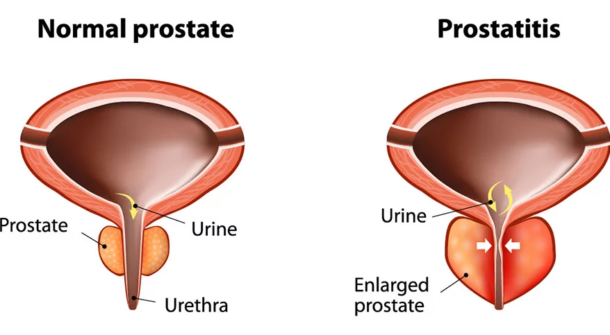 Prostatitis Treatment in Ahmedabad