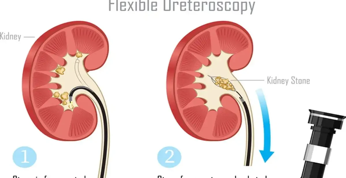 Retrograde Intrarenal Surgery (RIRS)