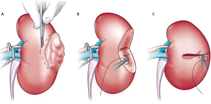 Robotic Partial Nephrectomy Surgery in Ahmedabad