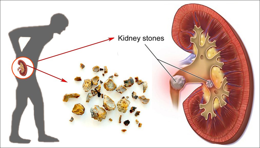 Ureteral Stone Treatment in Ahmedabad