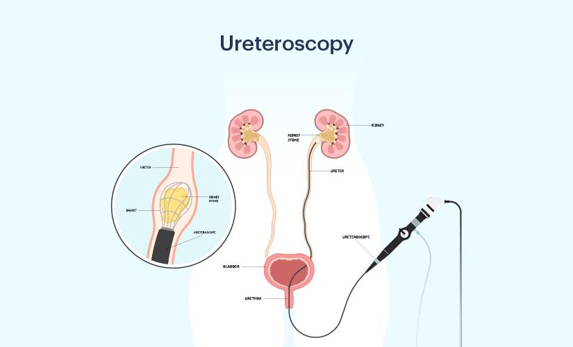 Ureteroscopy (URS) Surgery for Stone Removal in Ahmedabad