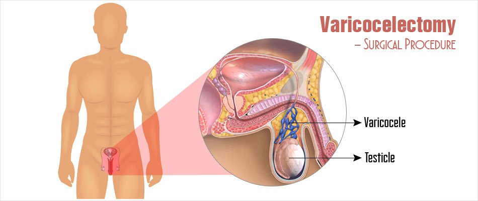 Varicocelectomy Surgery for Varicocele Repair