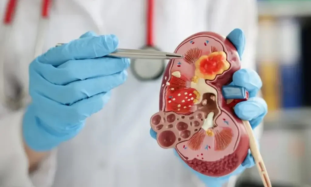 Kidney stone operation cost in Ahmedabad PCNL RIRS ESWL laser treatment Dr. Hardik Yadav urologist